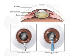 Cataract Surgery