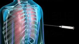 Transthoracic Needle Biopsy