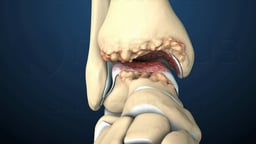 Anterior View of Ankle Arthritis with Bone Spurs