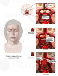 Intracranial Aneurysms