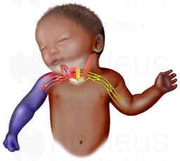 Shoulder Dystocia and Brachial Plexus Injury