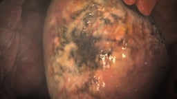 Atherosclerosis Bulleted Version