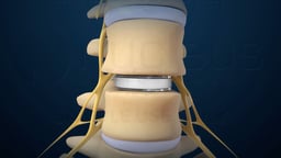 Lumbar Disc Replacement