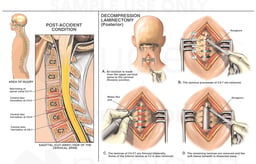 Post-accident Cervical Injuries with Surgical Repairs