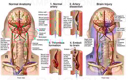 Vertebral Artery Dissection with Development of Emboli Resulting in Cerebral Infarction
