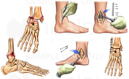 Trimalleolar Ankle Fractures (Broken Ankle) with Surgical Fixation