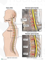 Intervertebral Disk Injuries