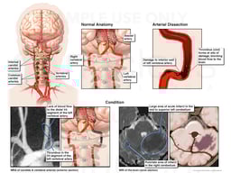Arterial Dissection and Stroke