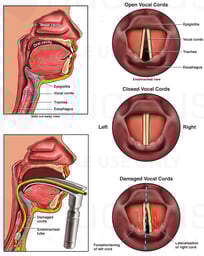 Prolonged Intubation with Damage to the Vocal Cords
