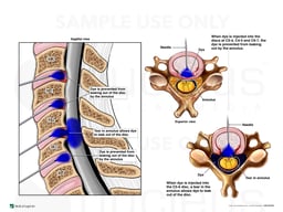 Multilevel Cervical Discography