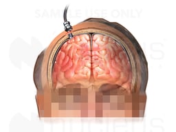 Intracranial pressure monitor (ICP)