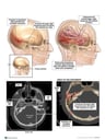 Skull Fracture with Loss of Hearing and Balance