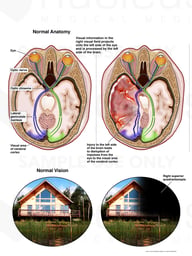 Traumatic Brain Injury with Resulting Visual Field Defects