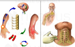 Post-surgical Reflex Sympathetic Dystrophy (RSD) of the Upper Extremity and Hand with Nerve Block Injection