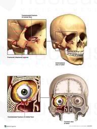 Right Orbital Fractures