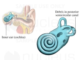 Benign Positional Vertigo (BPV)
