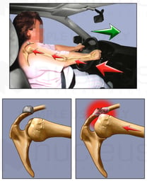 Mechanism of Shoulder Injury in Automobile Collision