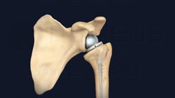 Reverse Total Shoulder Replacement in Scapula and Humerus