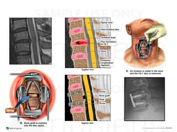 Cervical Spine Injury with Initial Discectomy and Fusion Surgery