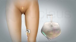 What Is a Foley Catheter?