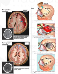 Intracranial Hemorrhage with Surgical Evacuation