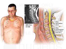 Traumatic Neck Injuries from Accident