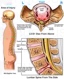Massive L5-S1 Lumbar Disc Herniation with Spinal Nerve Root Impingement