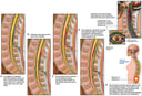 Development and Spread of Spinal Infection with Eventual Brainstem and Spinal Cord Damage
