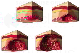 Pressure Sores: Four Stages