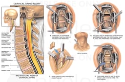 Traumatic Injury to the Cervical Spine with Surgical Repair