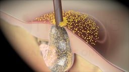 Bacterial Infection of a Clogged Hair Follicle