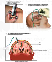 Brain Surgery - Placement of Intracranial Pressure Monitor (ICP)