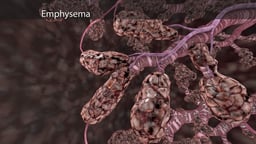 Emphysema: Structural Changes in Alveoli
