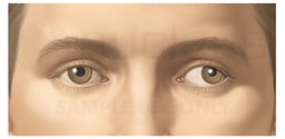Appearance of Strabismus (Impaired Side to Side Movement)