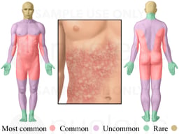 Allergic Reaction to Drugs