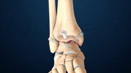 Anterior Ankle Fusion
