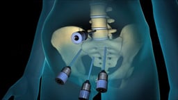 Laparoscopic Approach for Spinal Fusion