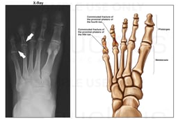 Left Toe Fractures X-Ray