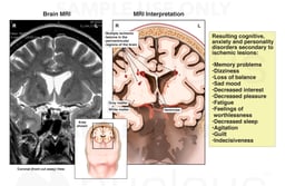 Traumatic Brain Injury