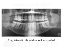 Dental X-ray