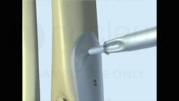 Fixation Surgery of Ankle Fracture