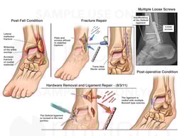 Left Bimalleolar Fracture with Surgical Repairs