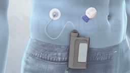 Opciones de tratamiento para la diabetes de tipo 1