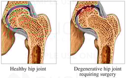 Degenerative Hip vs. Normal Hip