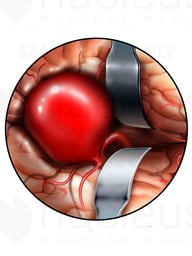 Aneurysm of the Cerebral Artery