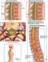 Spinal Hematoma Following Spinal Tap