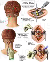 Chronic Migraine Headaches - Occipital Neuralgia with Surgical Procedures