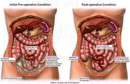 Appendicitis and Crohn’s Ileitis with Surgical Appendectomy