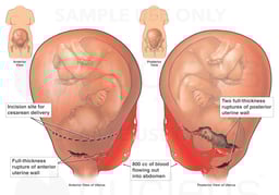 Uterine Rupture