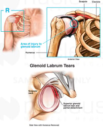 Glenoid Labrum Cartilage Injury of the Shoulder Joint